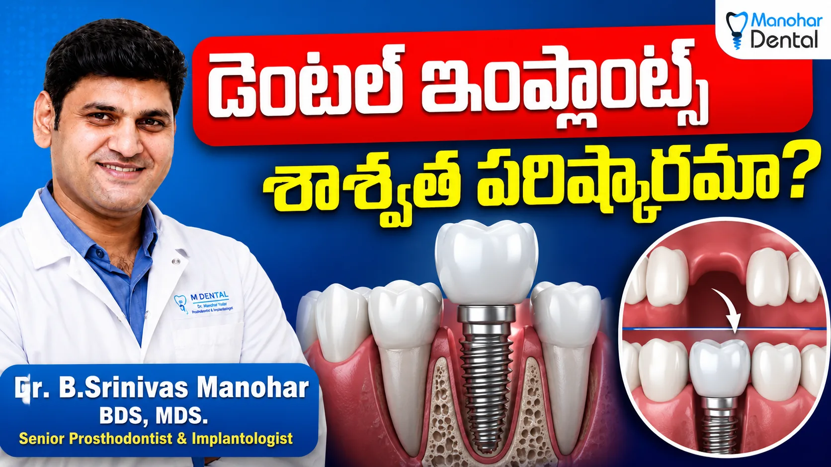 Dental Implants video thumbnail
